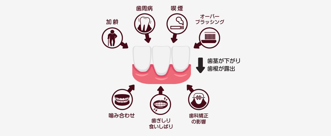 歯肉退縮の原因と症状
