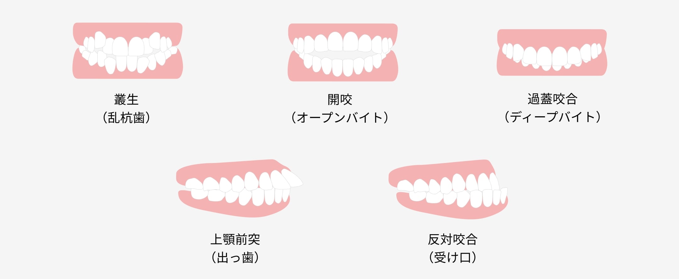 叢生(乱杭歯)、開咬(オープンバイト)、過蓋咬合(ディープバイト)、上顎前突(出っ歯)、反対咬合(受け口)
