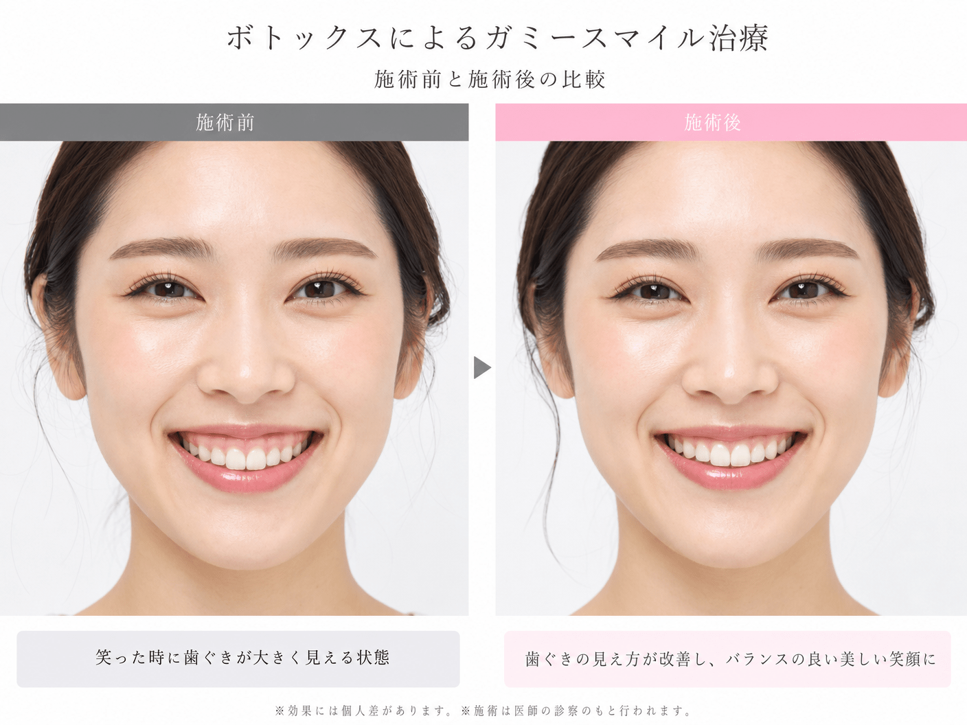 ガミースマイル治療のビフォーアフター