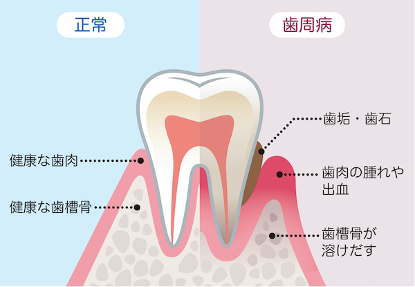 正常と歯周病の歯の比較