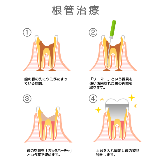 根管治療