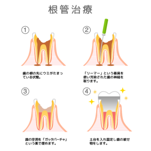 【歯科医監修】歯の神経治療とは?流れや費用、回数を全解説 | ミライズ矯正歯科南青山