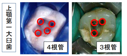 根管は単純な構造ではない