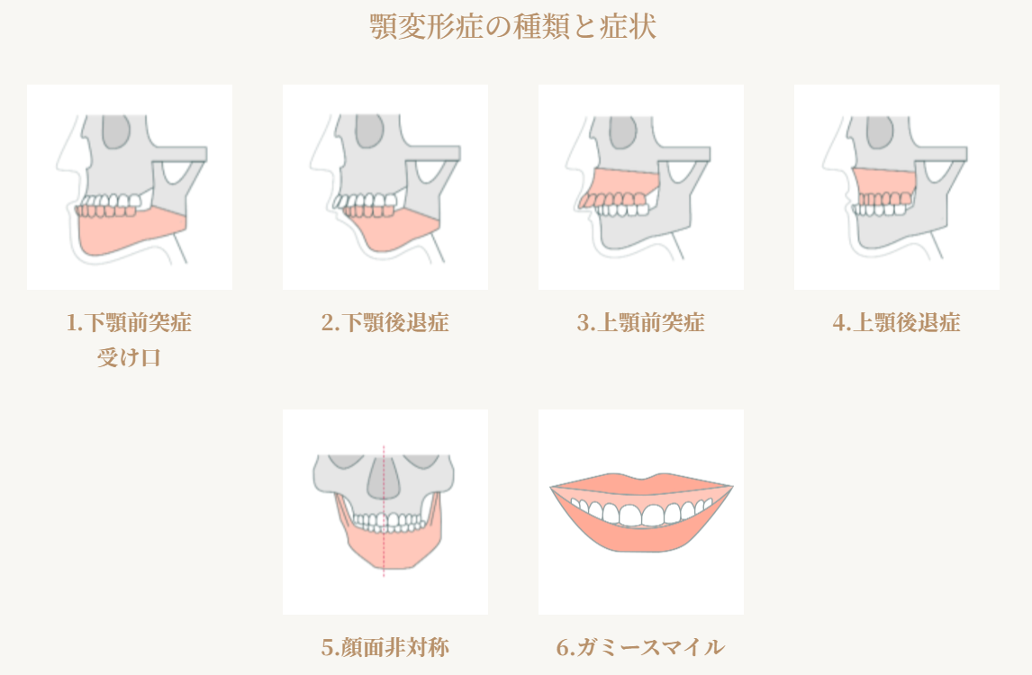 顎変形症の種類と症状