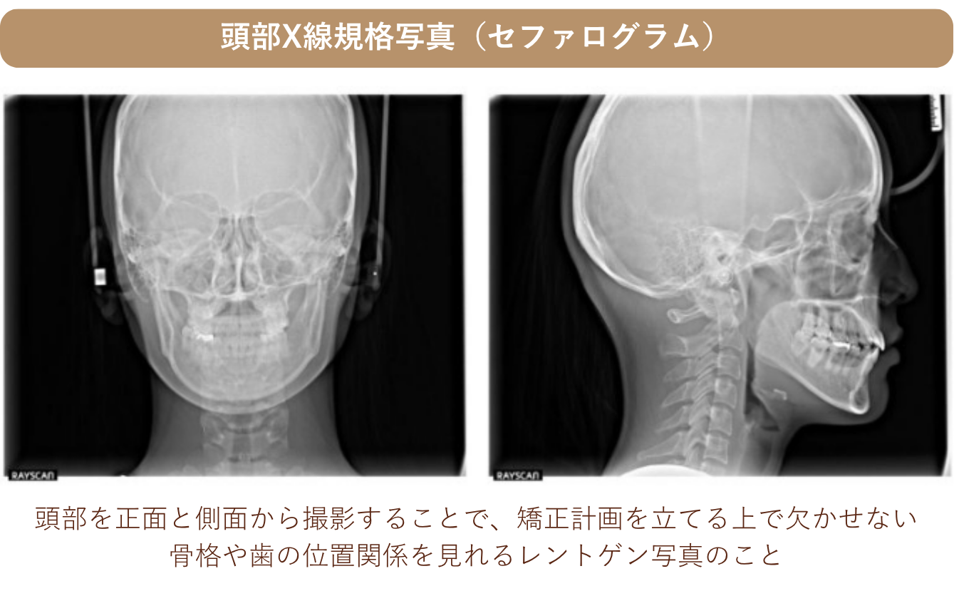 頭部X線規格写真(セファログラム)