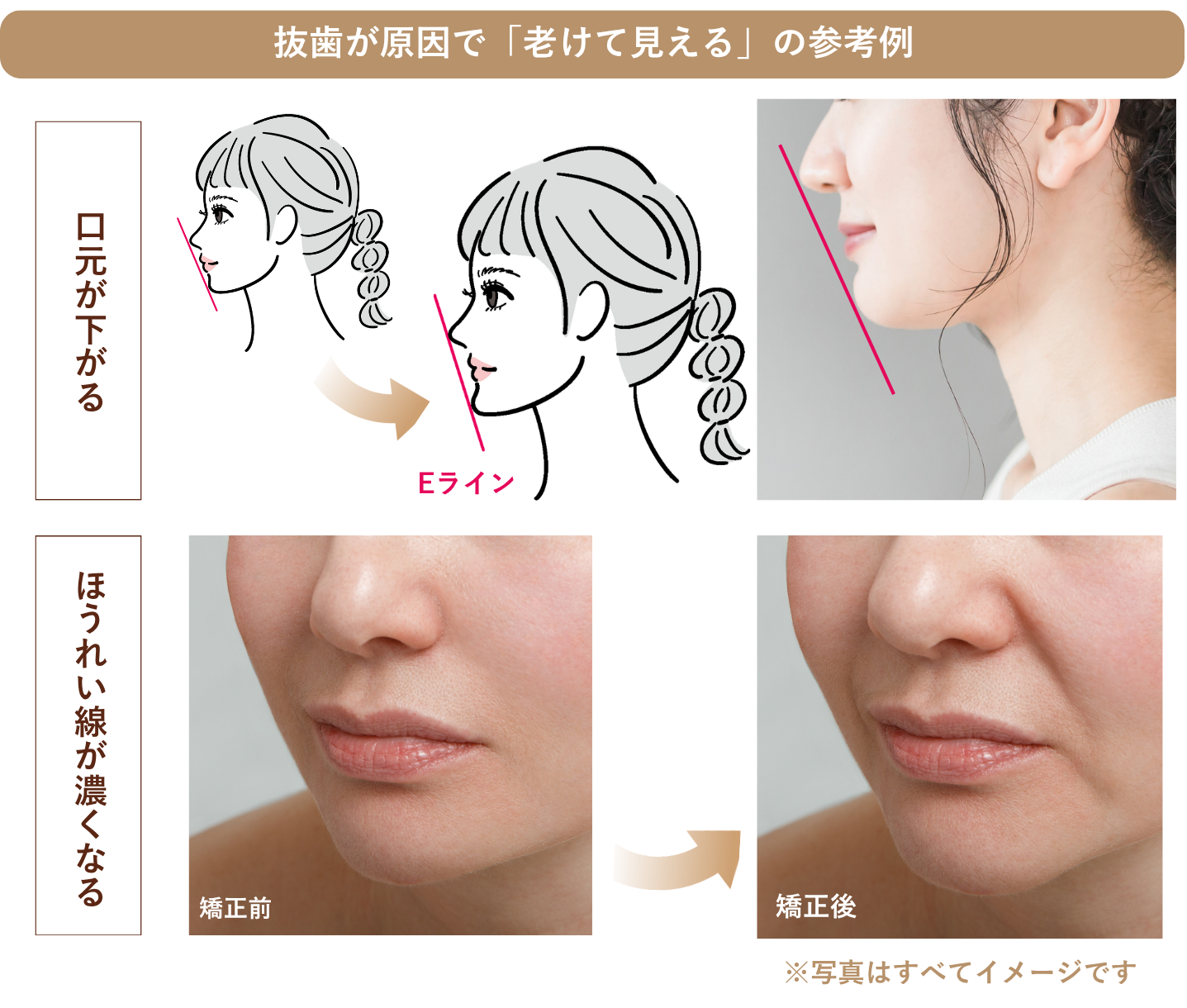 抜歯が原因で老けて見える参考例