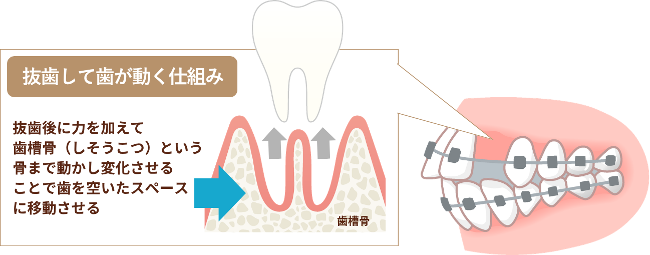 抜歯して歯が動く仕組み