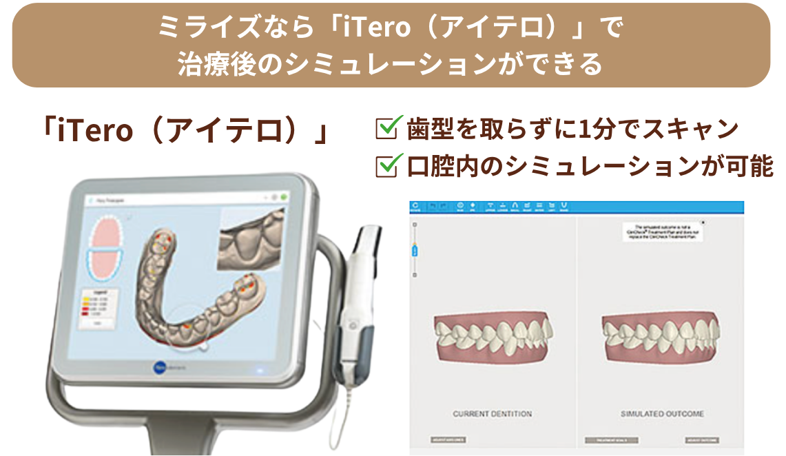 iTero(アイテロ)による治療後のシミュレーション