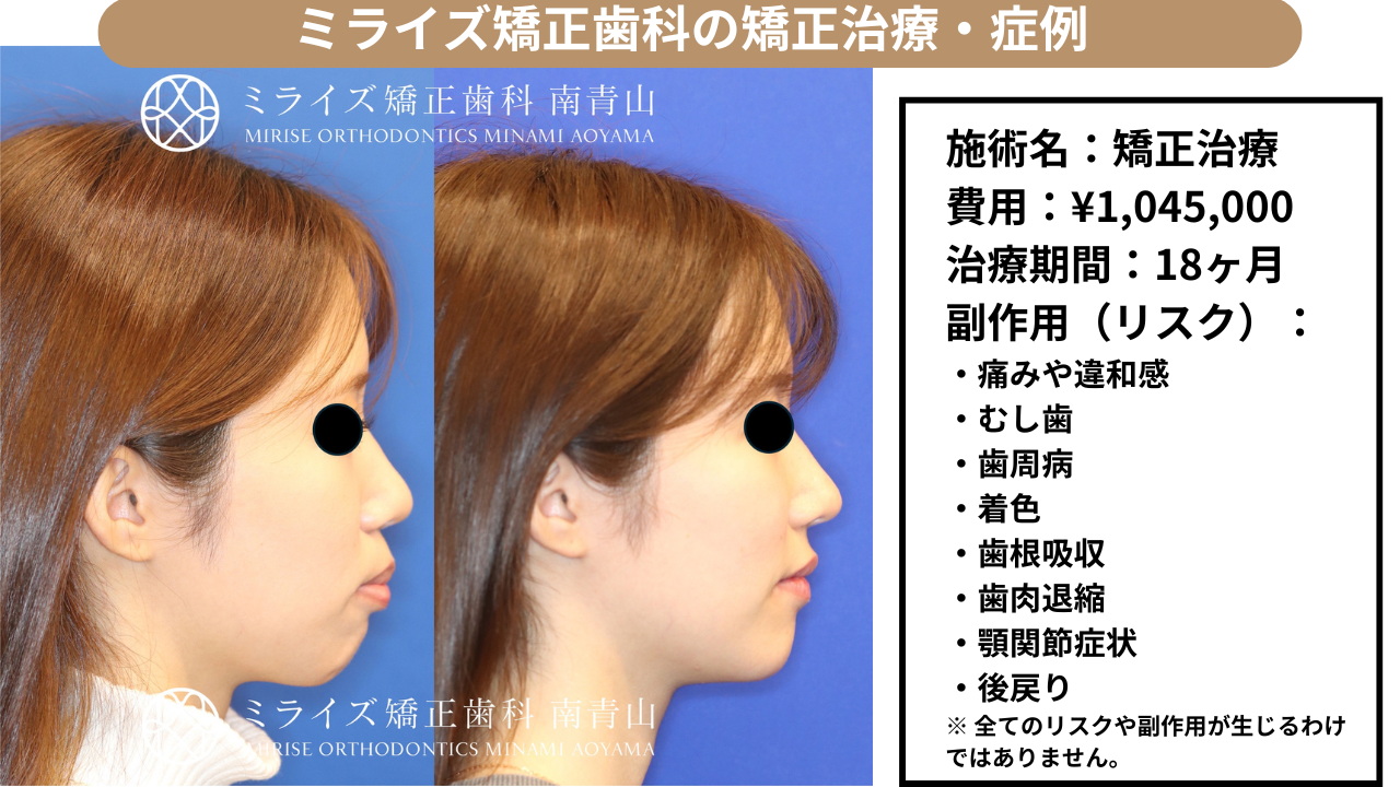 ミライズ矯正歯科の矯正治療・症例