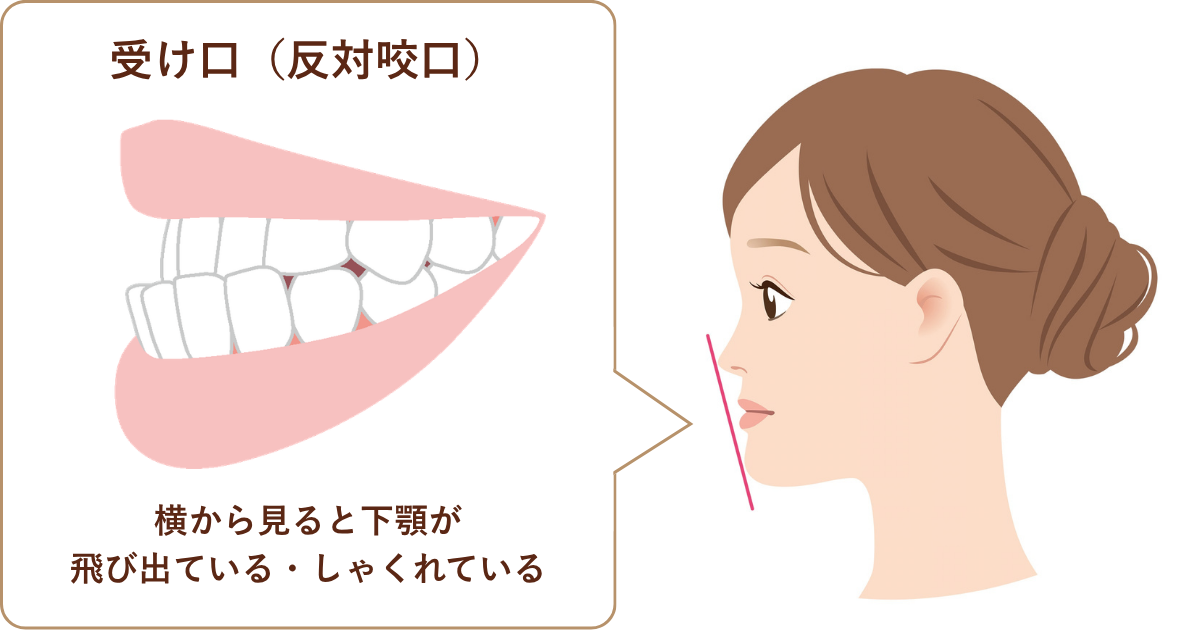 受け口(反対咬合)のイラスト