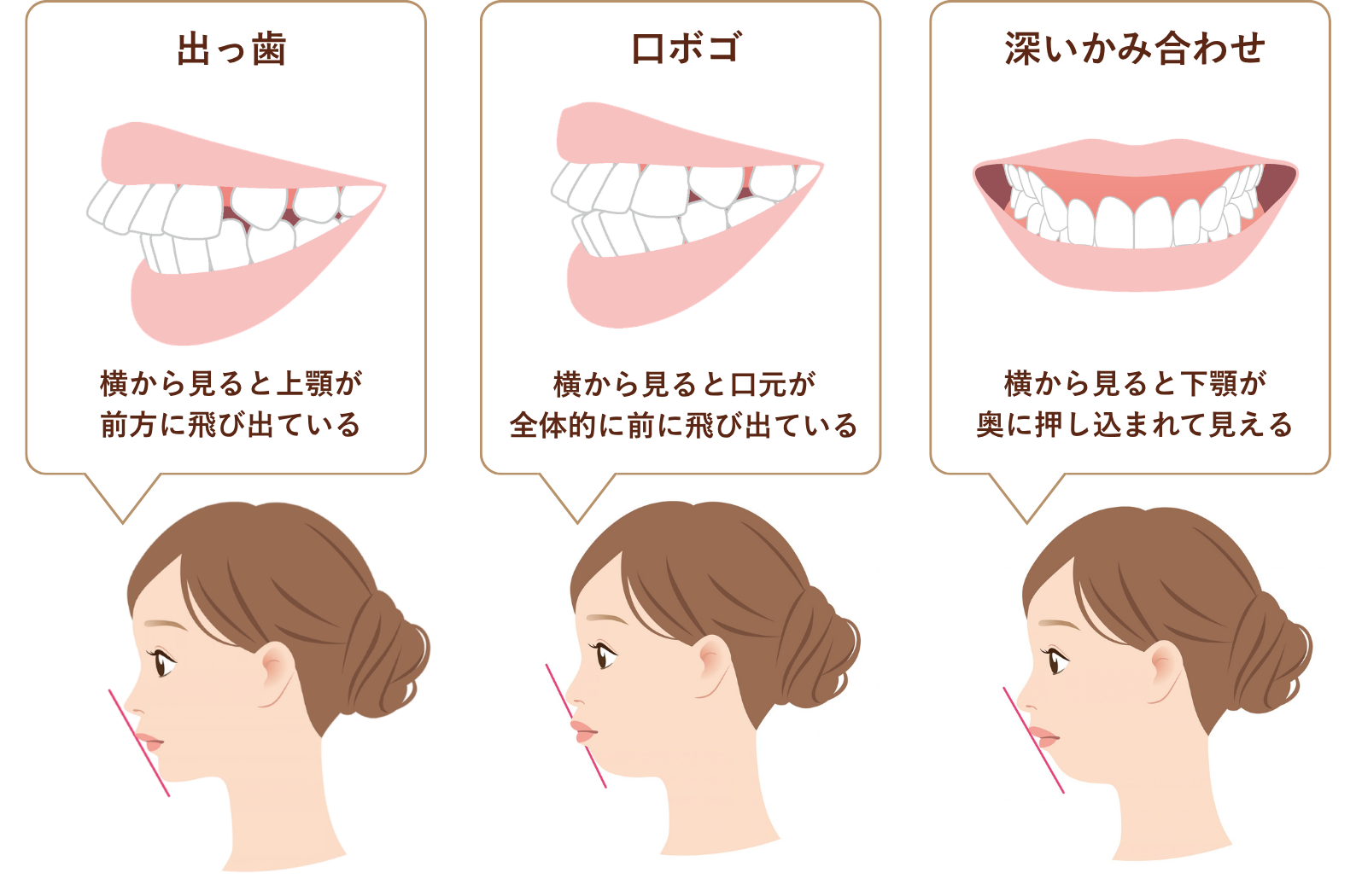 出っ歯・口ゴボ・深い噛み合わせのイラスト