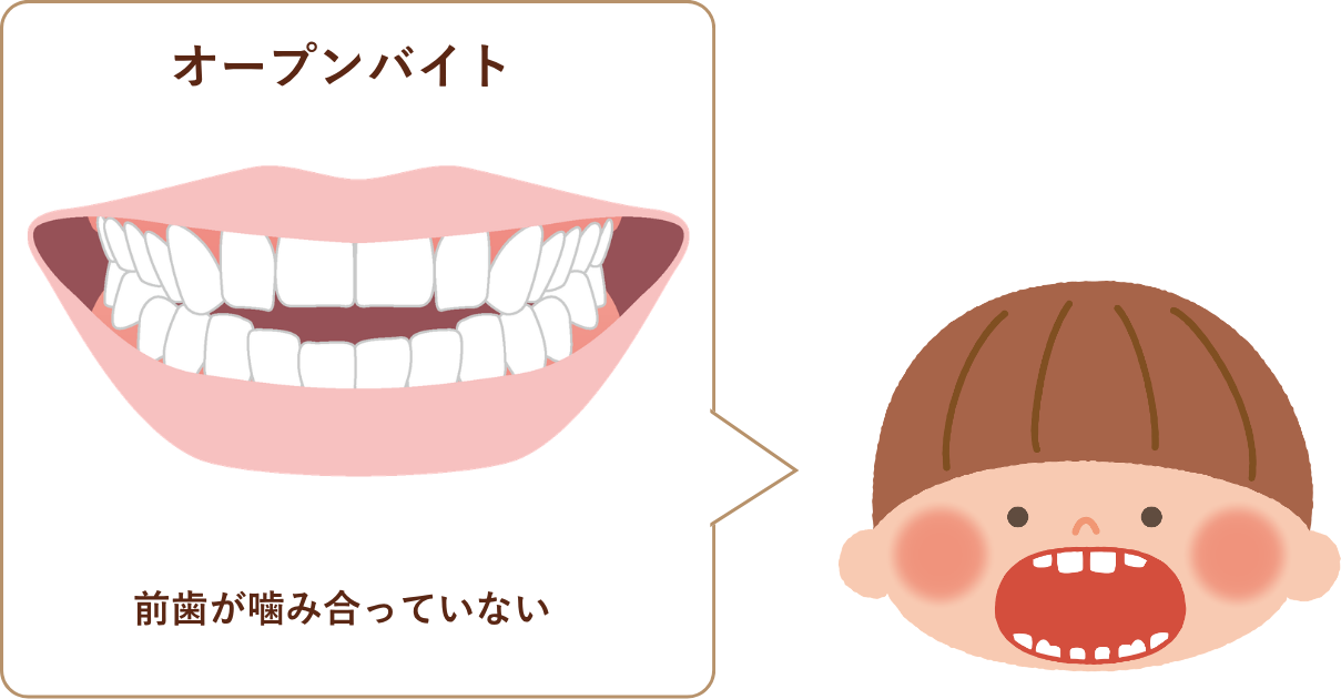 オープンバイト(開咬)のイラスト